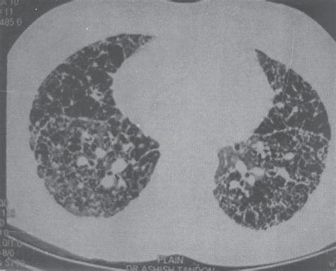 High Resolution Ct Thorax Revealed Thin Walled Cystic Spaces In Both