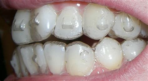 You shouldn't remove the invisalign attachments or button immediately on your own, even if you feel it's important to remove them as it can make the it will remove all it completely and leave the intact tooth surface. Sneek's Invisalign Treatment: I Got My Attachments
