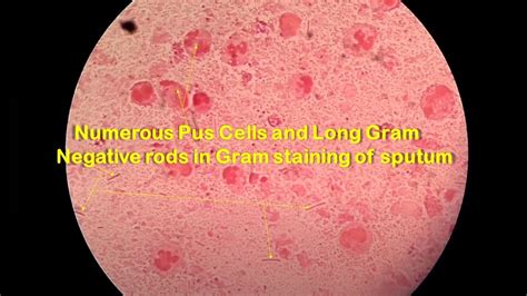 Long Gram Negative Rods And Numerous Pus Cells In Gram Stained Smear Of