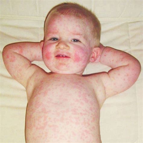 Body Red Rash Prickly Heat Sweat Eczema Itching Allergy Scratching