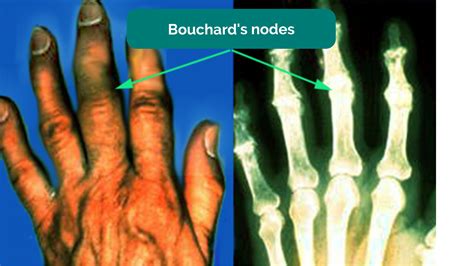 Hand And Wrist Examination Osce Guide Geeky Medics