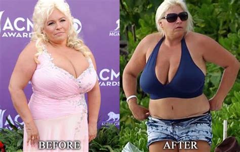 Beth Chapman Tummy Tuck Plastic Surgery Before After Breast Implants