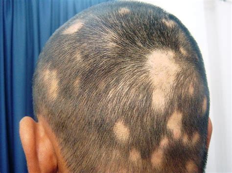 Hair Loss In Women And Men Causes Diagnosis And Hair Loss Treatment