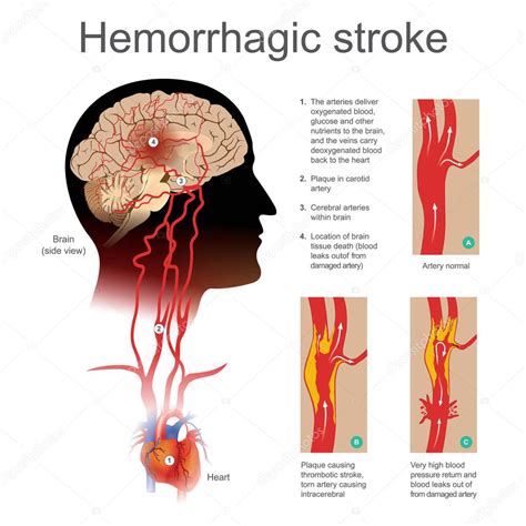 Hemorrhagic Stroke Plaque Causing Thrombotic Stroke Torn Artery