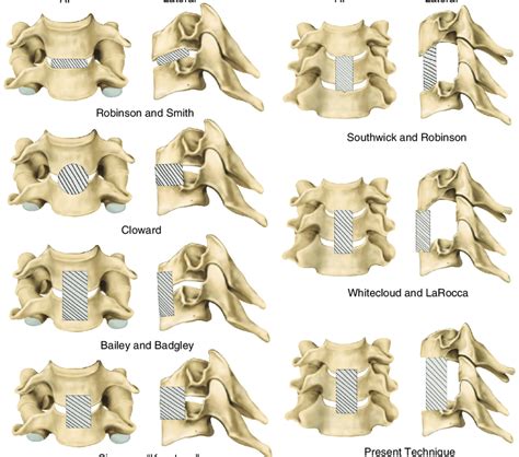Evolution Of Cervical Fusion Techniques The First Column Shows