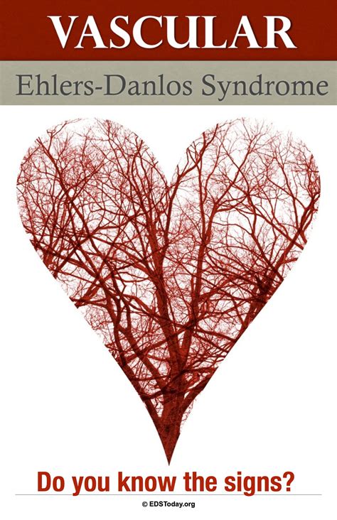 Vascular Ehlers-Danlos Syndrome (vEDS) | Ehlers danlos syndrome symptoms, Ehlers danlos syndrome 