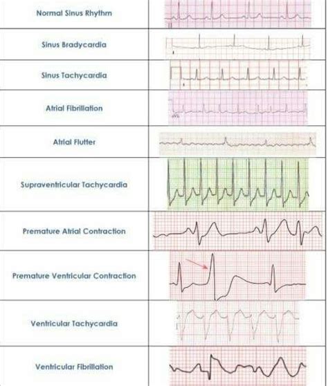 Ekg Cheat Sheet Ekg Rhythms Cardiac Rhythms Heart Rhythms Nursing
