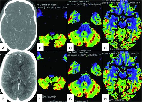 Ct Perfusion For Confirmation Of Brain Death American Journal Of