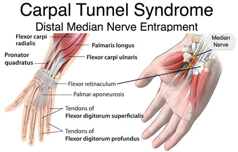 Carpal Tunnel Syndrome - Causes, Treatment, Splint & Surgery