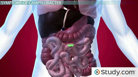 What Is Campylobacter Infection Caused By Campylobacter Bacteria