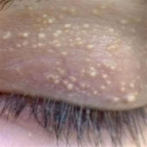 Strange Bumps Affect Millions But Treating Them Is As Simple As