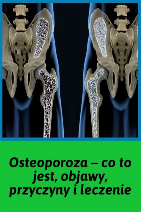 Osteoporoza co to jest jakie ma objawy i jak ją leczyć The Best Porn