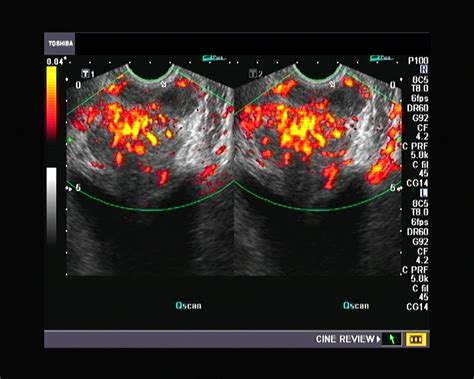 Ultrasound And Color Doppler Videos Prostate Transrectal Ultrasound Quiz
