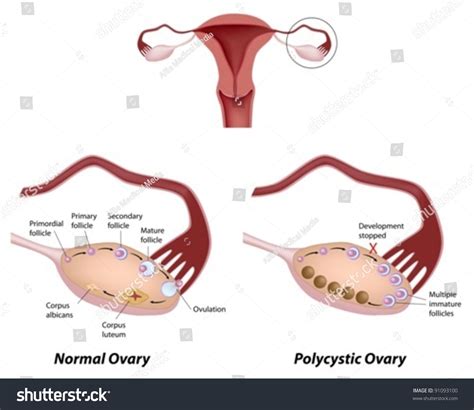 Uterus And Ovary Anatomy Model With Pathologies Ebay