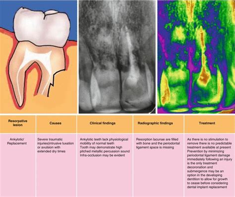 Root Resorption Pocket Dentistry Periodontitis Intraoral Impacted
