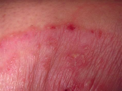 Common Rashes Found In The Armpits