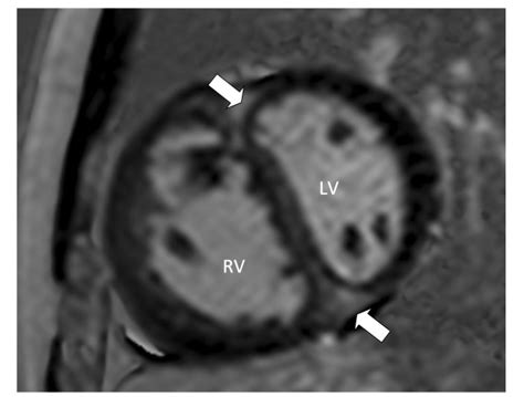 Late Gadolinium Enhancement Of Right Ventricular Insertion Point This