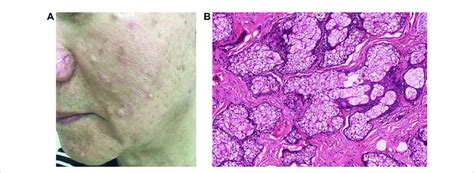 Skin Colored Papules Represent Hyperplastic Sebaceous Glands