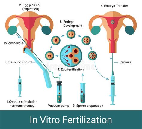 paso de fertilización in vitro médico que coloca el embrión en el útero femenino ilustración