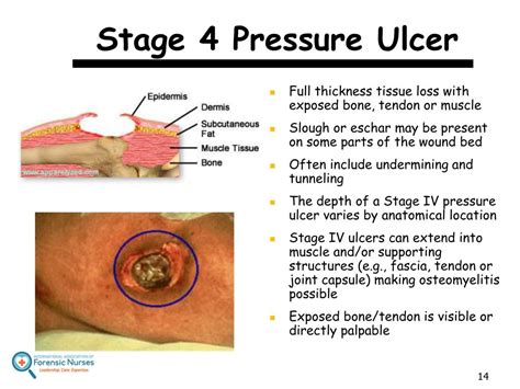 Stage 4 Pressure Ulcer Treatment