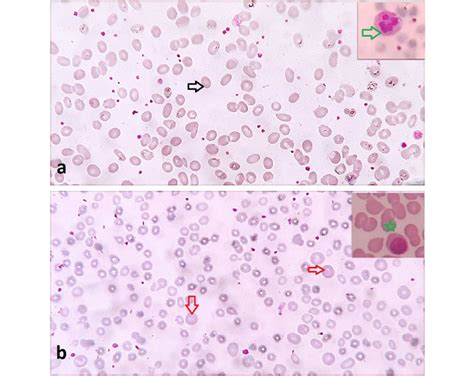 A Peripheral Smear In Case 1 Showing Macro Ovalocytes Black Arrow And