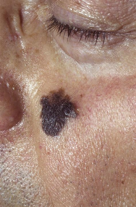 Lentigo Maligna Melanoma Skin Cancer Stock Image C0402260