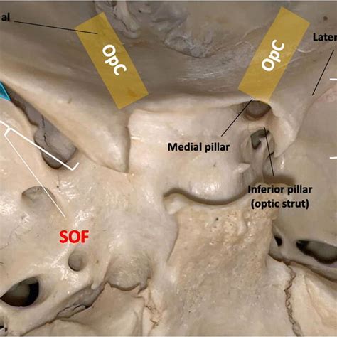 Dry Skull Showing The Anatomic Configuration Of The Anterior Clinoid