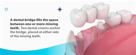 Dental Crowns Vs Bridges Vs Implants — Which Is Best
