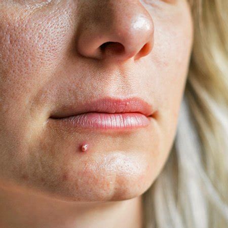 Many have claimed this to be pimples or other unsightly skin conditions or the obvious culprit of hsv1. Pimple vs. Cold Sore: Learn the Differences & Similarities