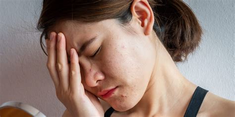 Stress Acne Why It Happens And How To Get Rid Of It