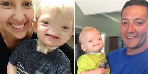 Eli Thompson Boy Born Without A Nose Dies At Two Years Old