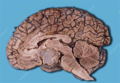 Dermoid Cyst In The Brain Stock Image M1300927 Science Photo Library