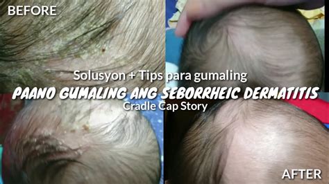Seborrheic Dermatitis Cradle Cap Tips Remedies Youtube