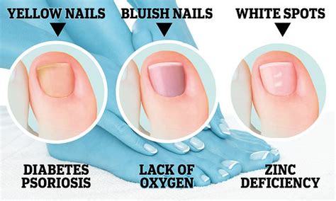 Expert Reveals What Your Toenails Say About Your Health