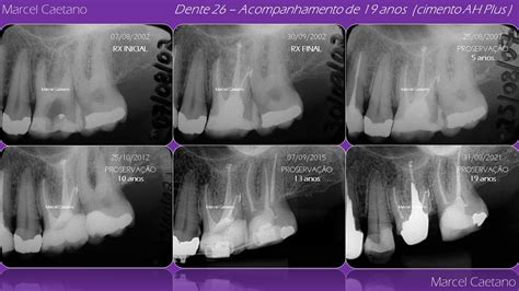 Endodontia Avançada Proservação clínica radiográfica de anos de tratamento endodôntico em