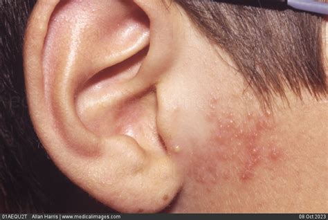 Stock Image Close Up Of Shingles Herpes Zoster Showing A Red Inflamed