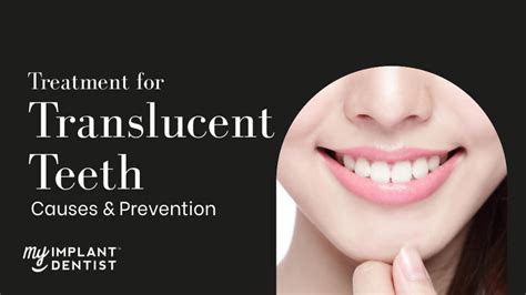 Translucent Teeth Causes Treatment And How To Fix It