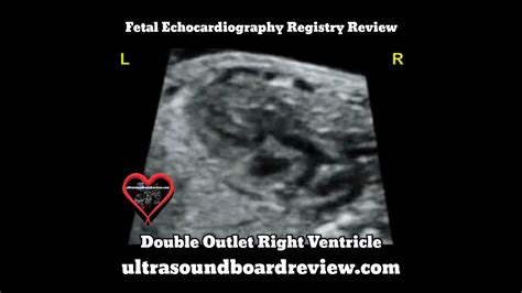 Double Outlet Right Ventricle Fetal Echocardiography Youtube