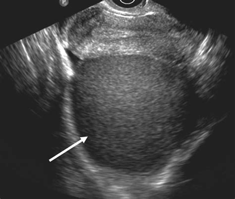 Unusual Manifestations and Complications of Endometriosis—Spectrum of