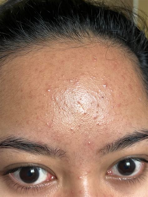 Fungal Acne Supplements Work Rfungalacne