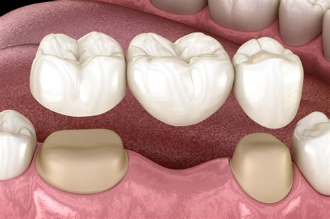 Dental Bridges Ridgewood NJ Replace Single Or Multiple Missing Teeth