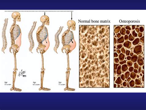 Bone Density Problems Low Bone Density Fact Sheets Yale Medicine