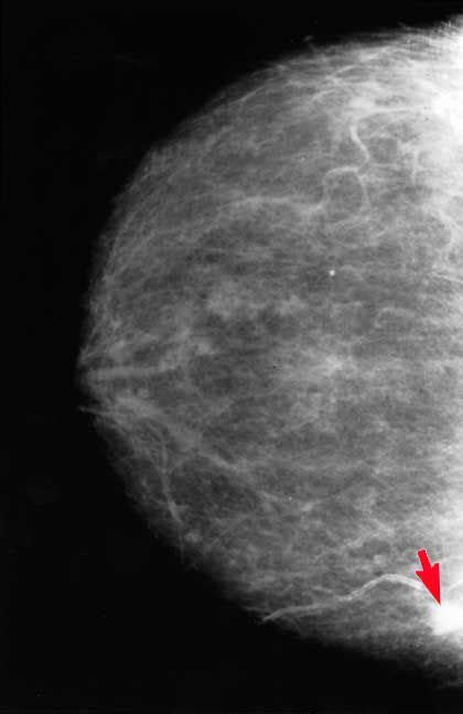 Mammogram Images Normal And Abnormal
