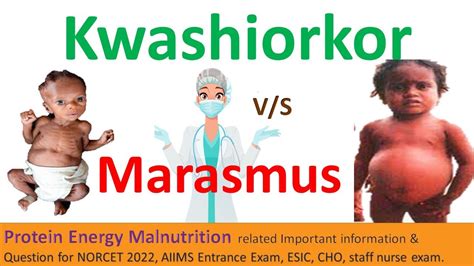 Proteinenergymalnutrition Kwashiorkor Marasmus Calories Protein