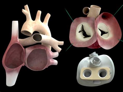 The Worlds First True Artificial Heart Now Beats Inside A 75 Year Old