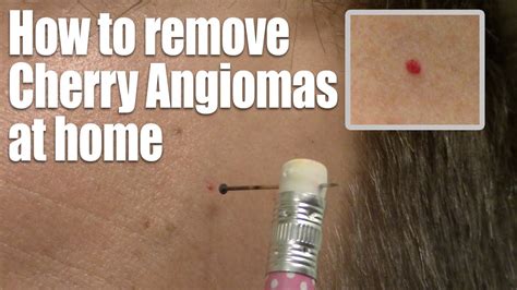 Cherry Angioma On Face Removal At Home Removing Cherry Angioma In 5 Easy Home Remedy Steps