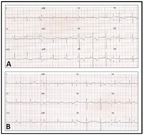 Figure 1 From The Evolution Of Electrocardiographic Signs Of Right