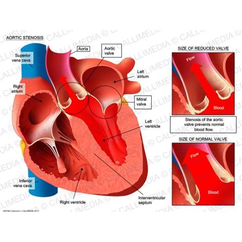 Best 25+ Aortic stenosis ideas on Pinterest | Cardiac nursing, Cardiac