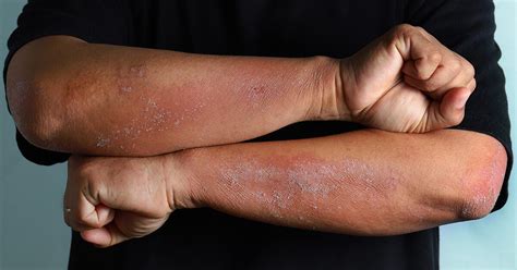 How To Spot Mild Moderate And Severe Psoriasis