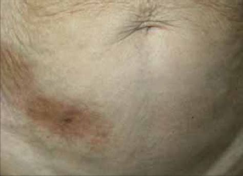 A Characteristic Lesion Of Morphea Well Defined Indurated Plaque In